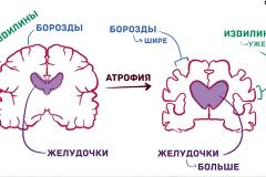 Челябинский врач рассказал, как снизить риск развития деменции