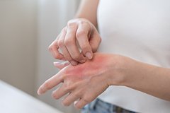 Silnyj zud u bolnoj rakom 15 letnej devushki vrachi prinjali za allergiju 2d61ed2.jpg