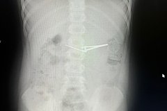 V rossijskom gorode doshkolnik proglotil shhipcy dlja strizhki nogtej dea3152.jpg